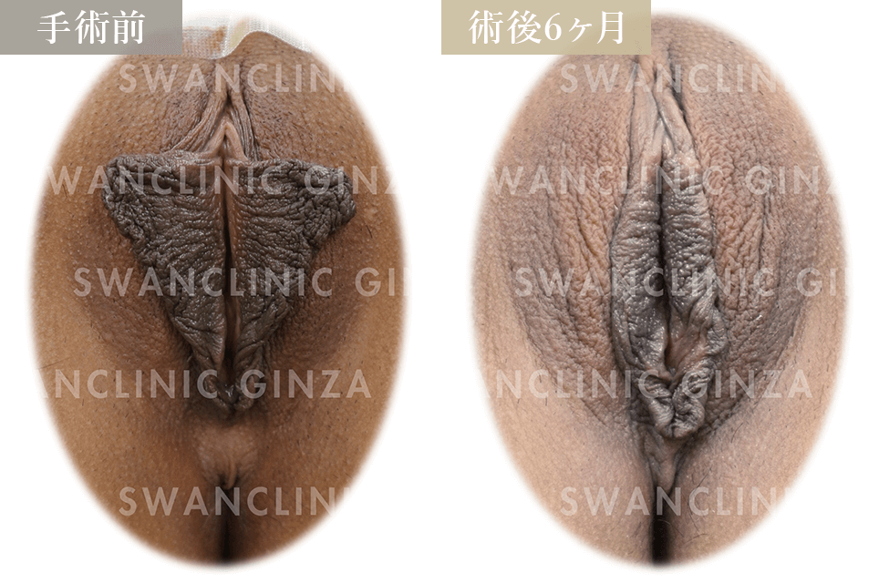 小陰唇縮小術＋副皮切除