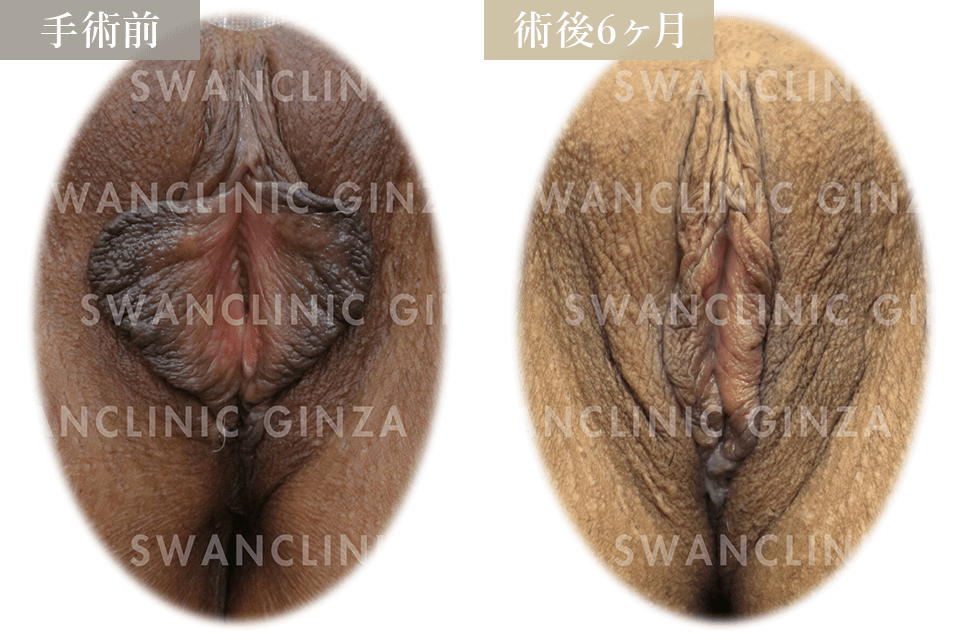 小陰唇縮小術＋副皮切除