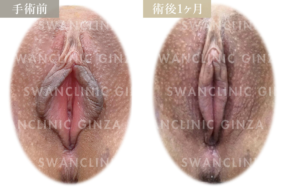 小陰唇縮小術＋副皮切除