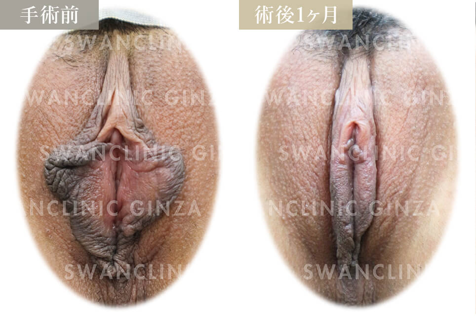 小陰唇縮小術＋副皮切除