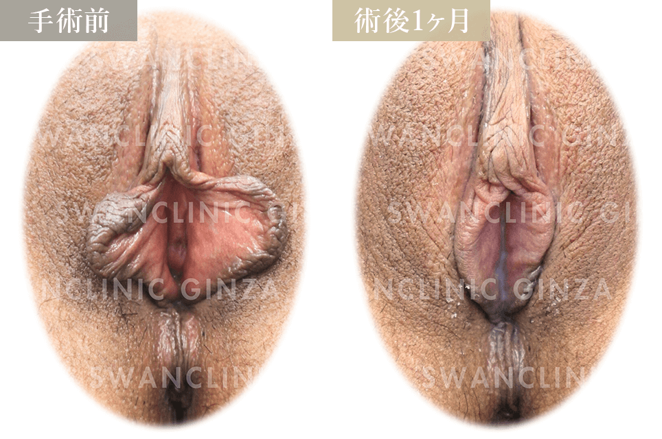小陰唇縮小術＋副皮切除