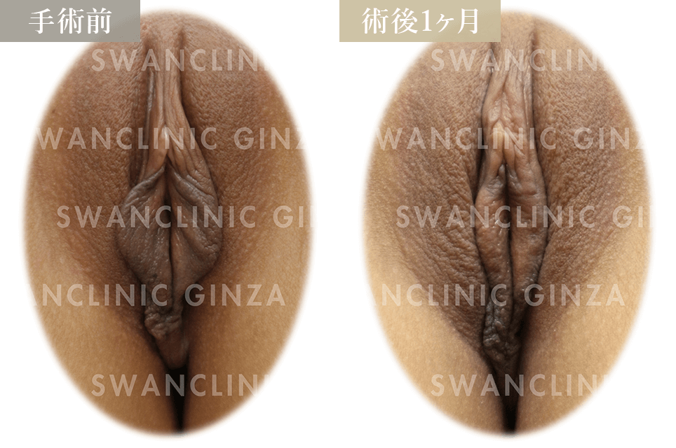 小陰唇縮小術＋左副皮切除