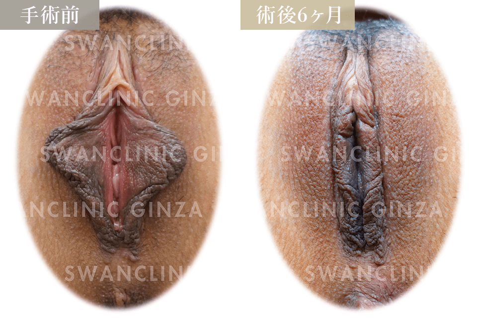 小陰唇縮小術＋副皮切除