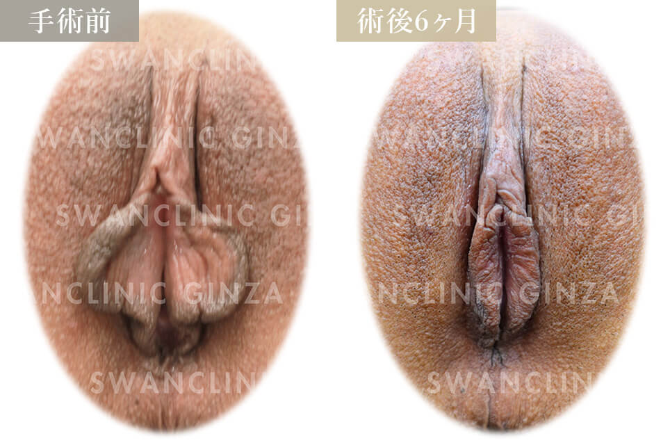 小陰唇縮小術＋左副皮切除