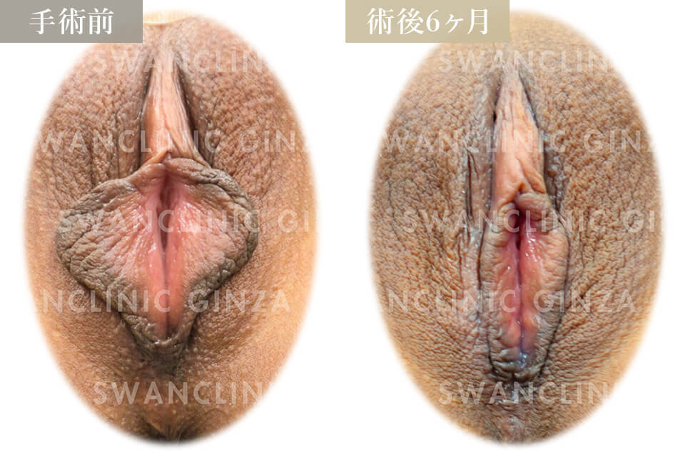 小陰唇縮小術＋副皮切除