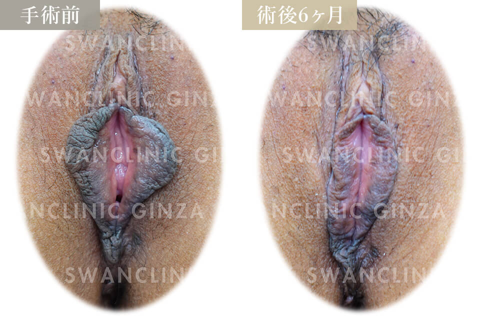 小陰唇縮小術＋副皮切除