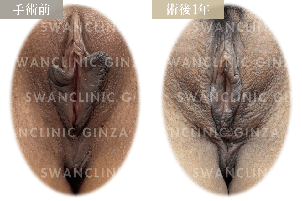 小陰唇縮小術＋副皮切除