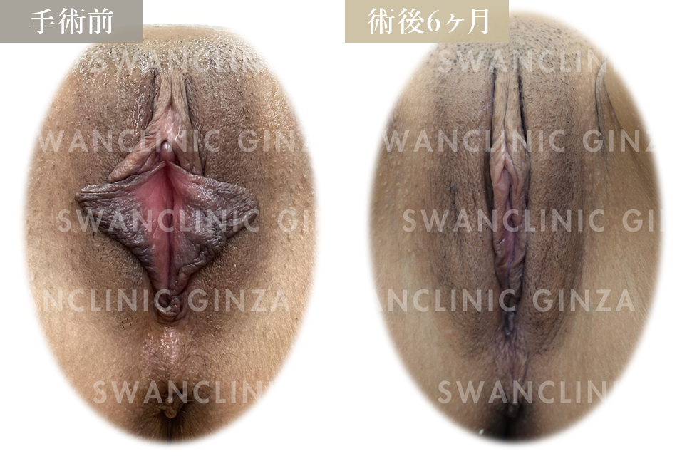 小陰唇縮小術＋副皮切除