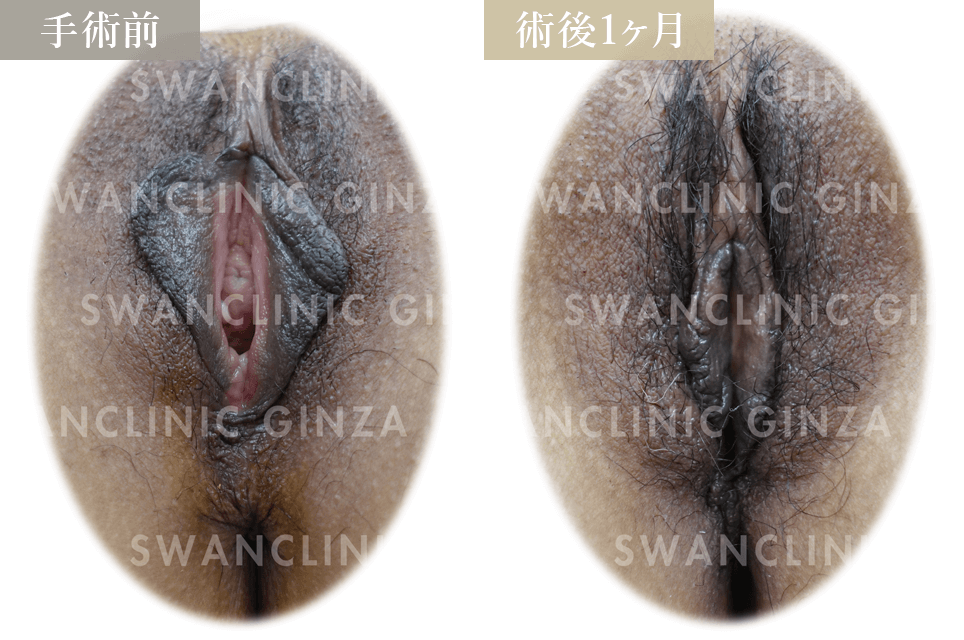 小陰唇縮小術＋左副皮切除