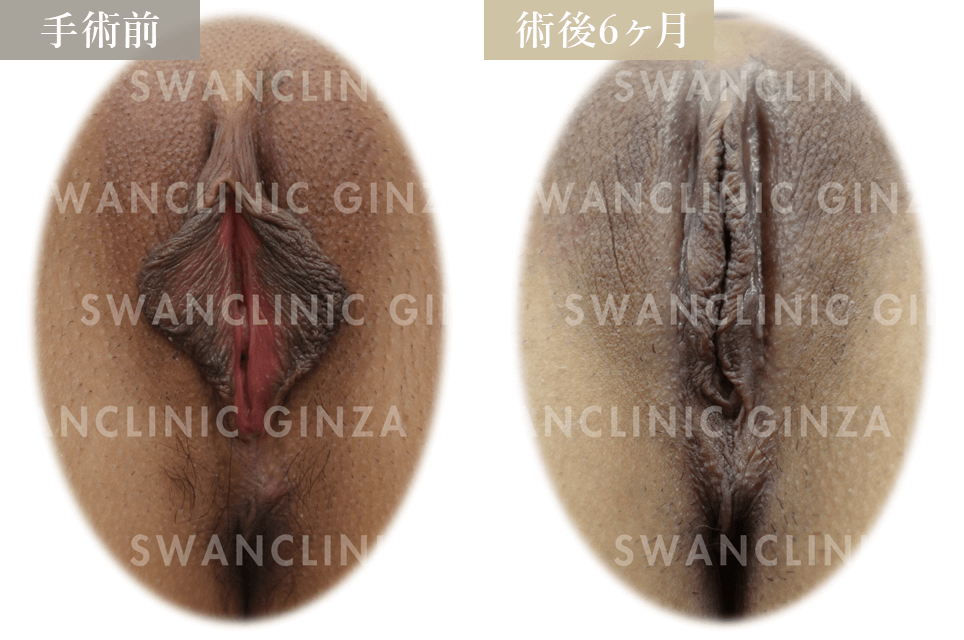 小陰唇縮小術＋副皮切除