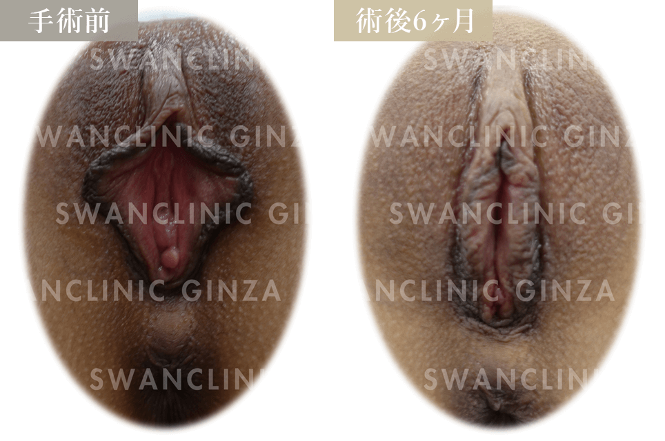 小陰唇縮小術＋副皮切除