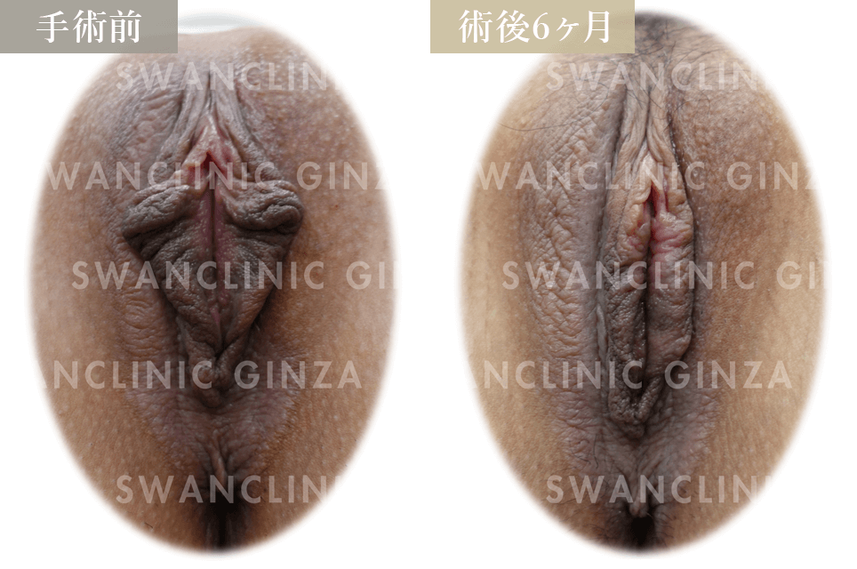 小陰唇縮小術＋副皮切除