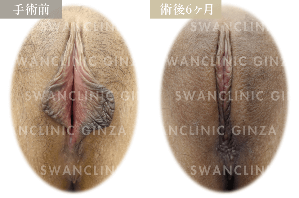 小陰唇縮小術＋副皮切除