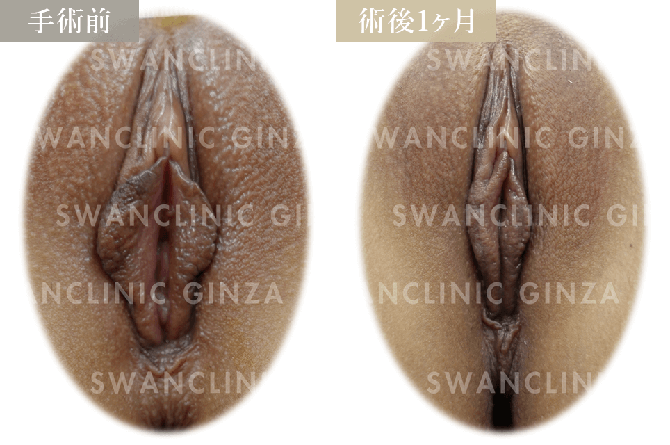 小陰唇縮小術＋副皮切除