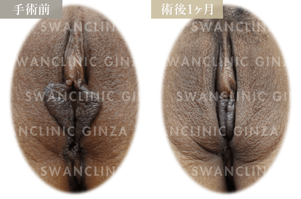 小陰唇縮小術＋副皮切除