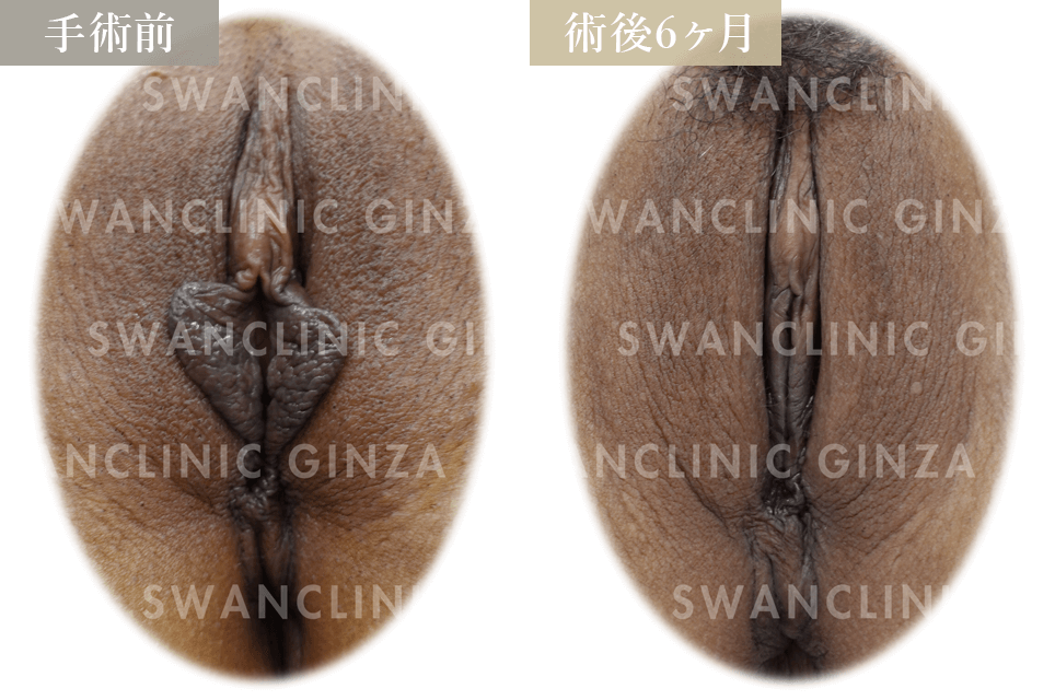 小陰唇縮小術＋副皮切除
