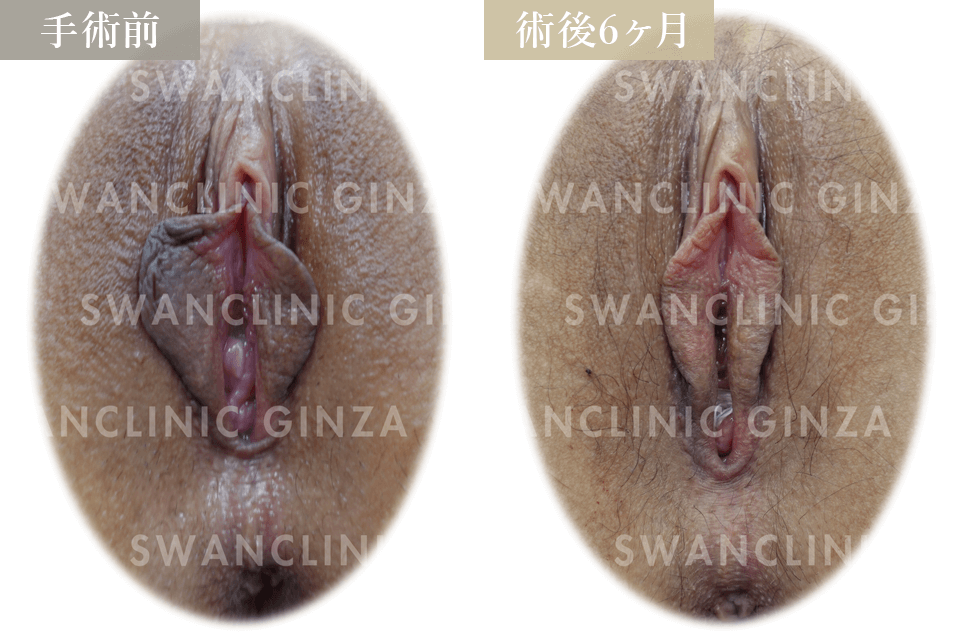 小陰唇縮小術＋右副皮切除