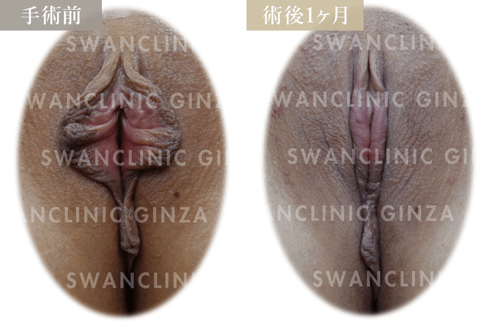 小陰唇縮小術＋副皮切除