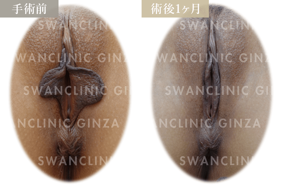 小陰唇縮小術＋左副皮切除