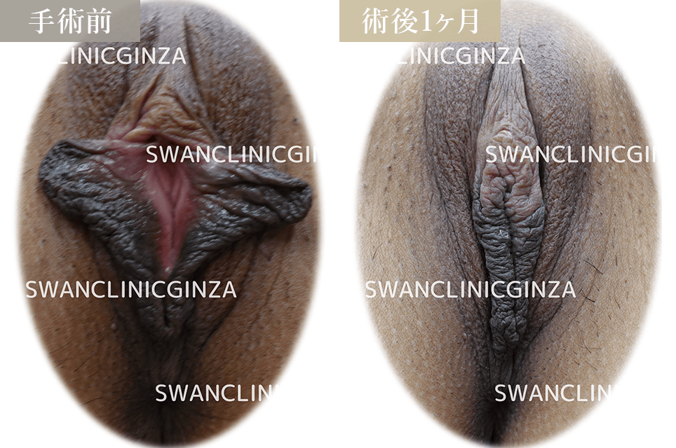 小陰唇縮小術＋副皮切除